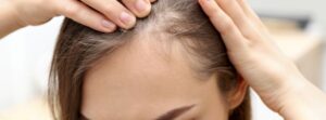 queda de cabelo tem tratamento em clínica de dermatologia