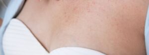 Colo feminino com marcas de alergia de pele: