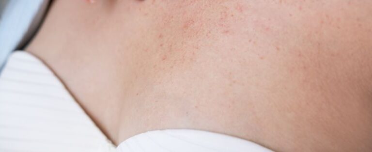 Alergia de pele: descubra o porquê ela acontece e como tratar