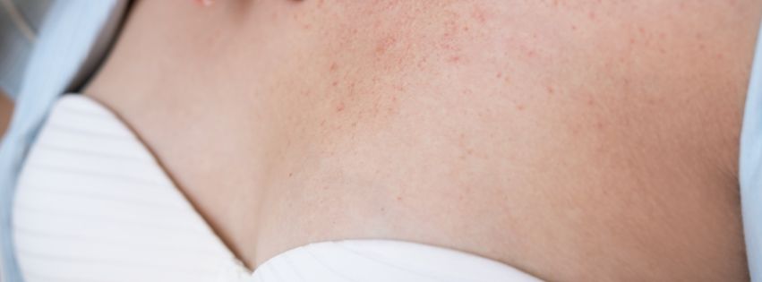 Colo feminino com marcas de alergia de pele: