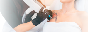 Remoção de tatuagem a laser: saiba como funciona