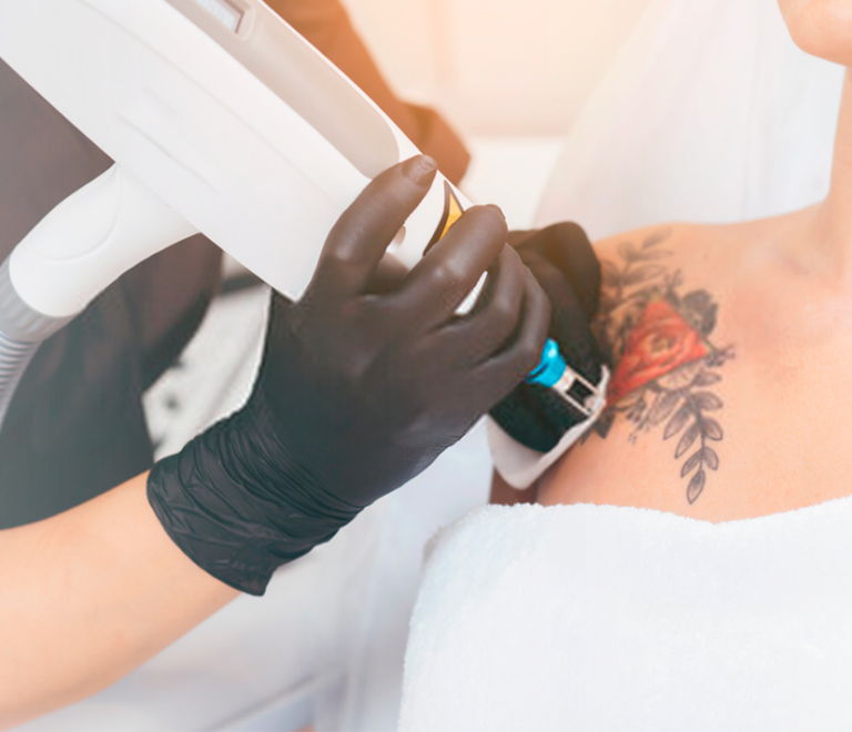 Remoção de tatuagem a laser: saiba como funciona