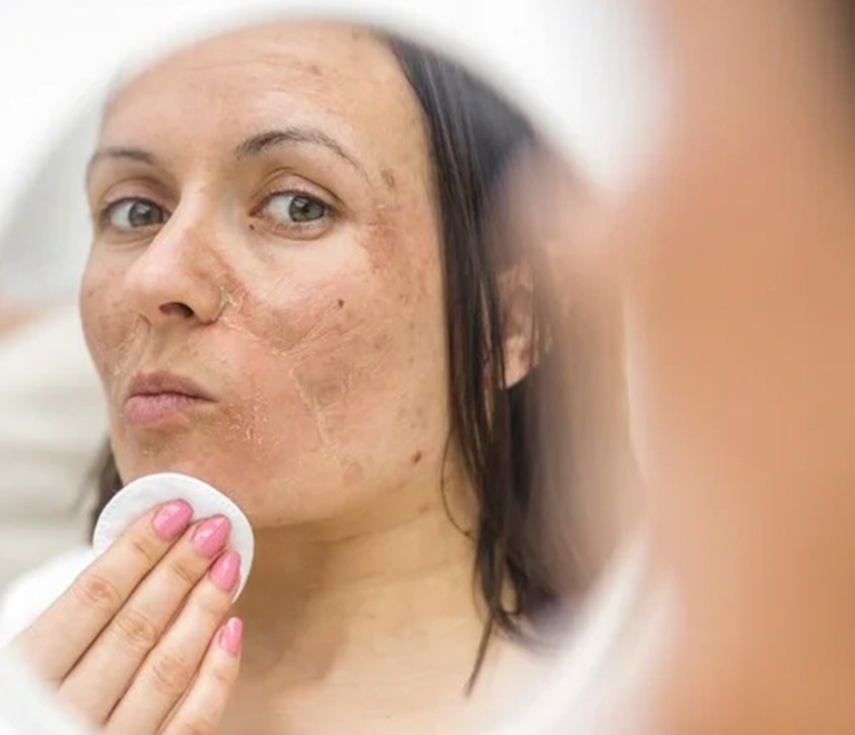 Melasma: conheça as causas e tratamentos