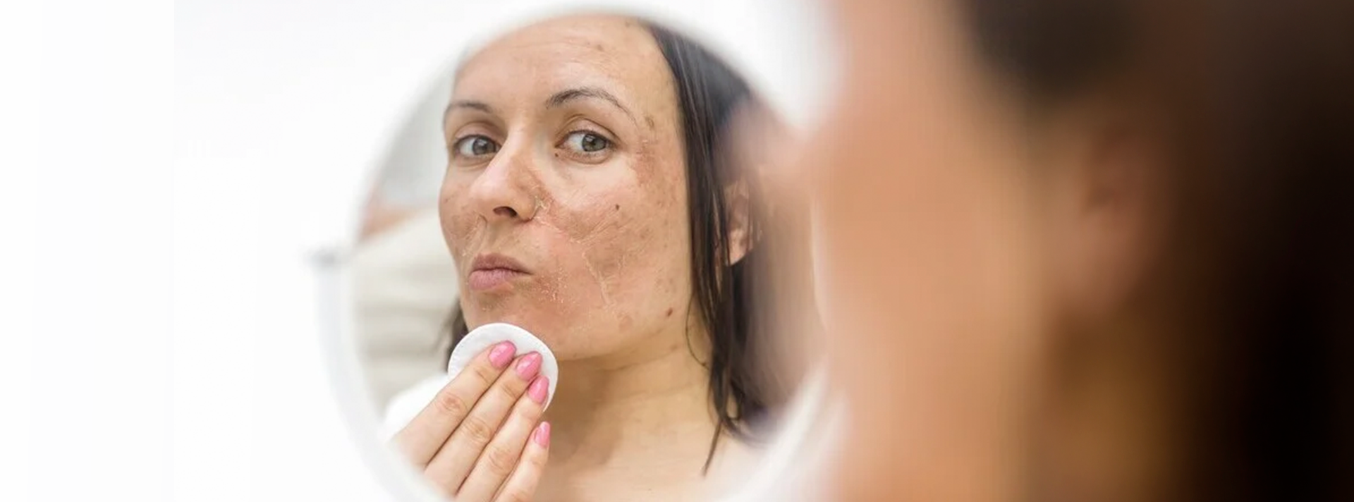Melasma