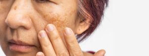 Melasma 